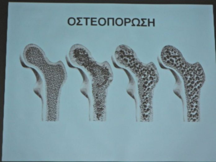 Εκδήλωση για την πρόληψη της οστεοπόρωσης